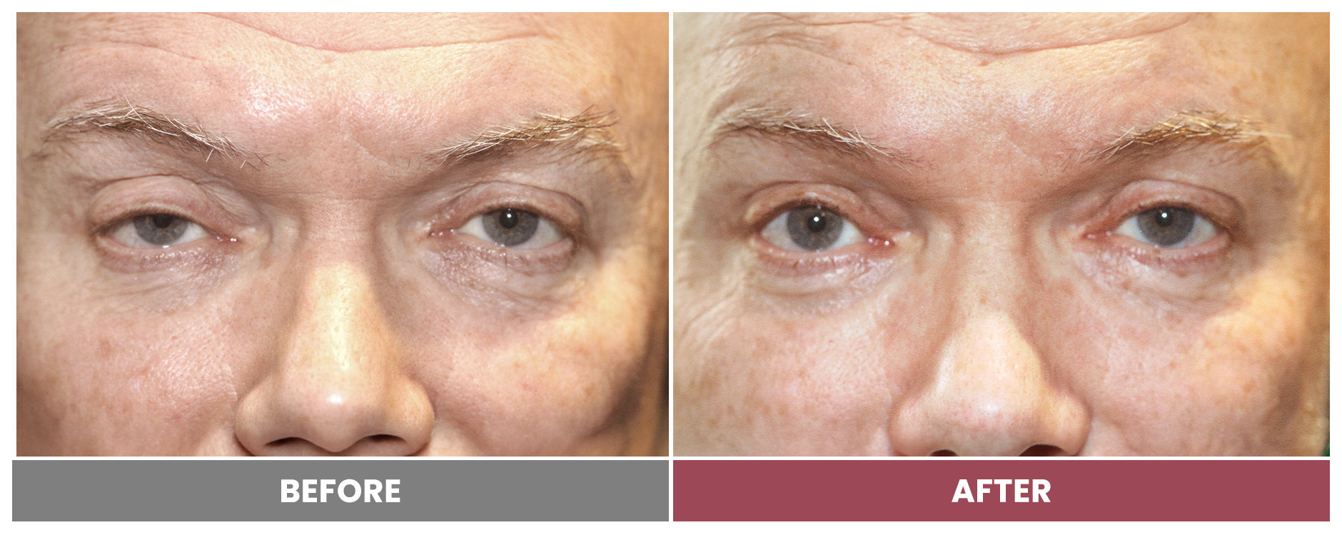 PTOSIS REPAIR - Case 29